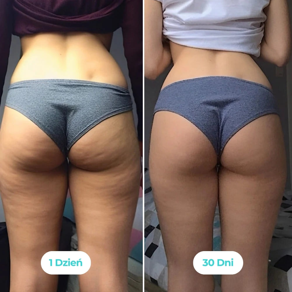 Vibraskin® - Poprawia wygląd skóry